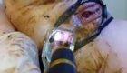 Poop Through Anus Speculum