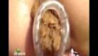 Anal speculum and poop through and prolapse